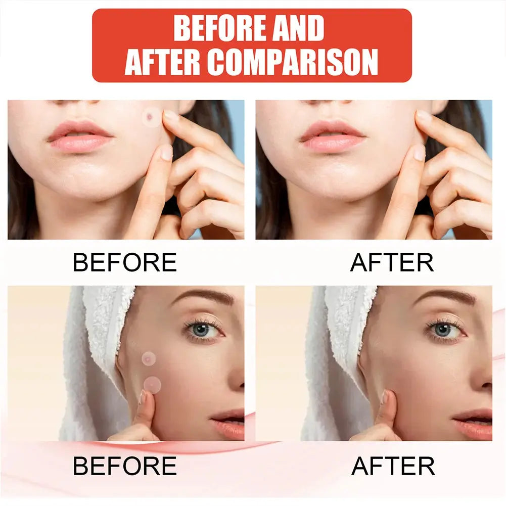 Invisible Acne Healing Patches Nivora Lux